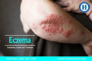 Best Homeopathy Treatment For Eczema Skin Disorder In Tumkur